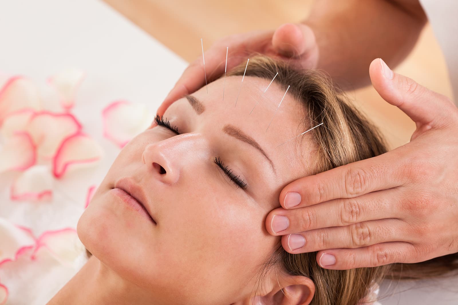 how much is acupuncture - Woman undergoing acupuncture treatment